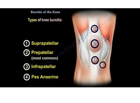 anterior view of bursitis.